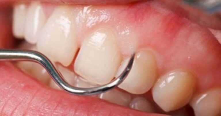 خراج اللثة العلوية